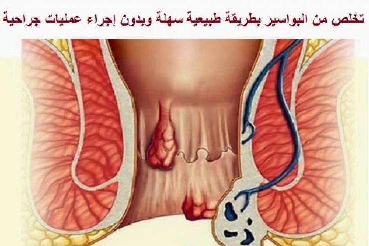 علاج البواسير - افضل الوسائل للتخلص من الم البواسير 3523