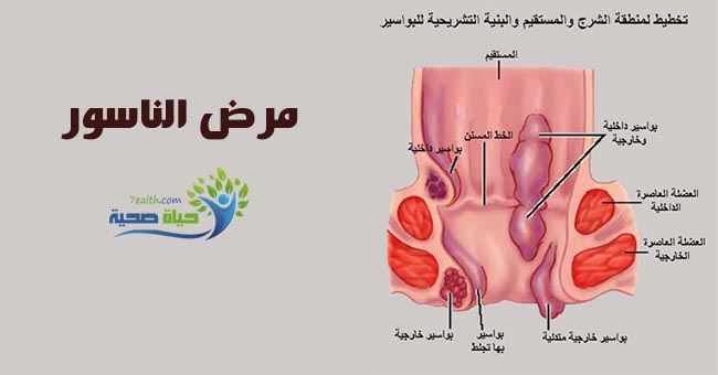 ما هو الناسور - اهم اعراض مرض الناسور 1674