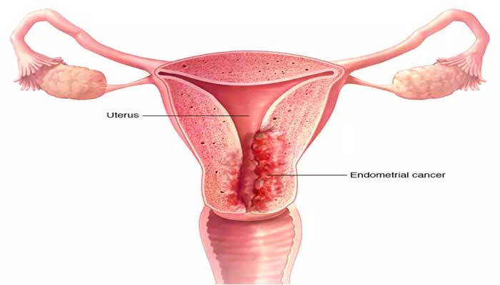 اعراض سرطان الرحم - كيف تعرفين انك اصبت بسرطان الرحم 2540 1