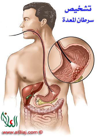 اعراض سرطان المعدة - اسباب سرطان المعدة 1611 1