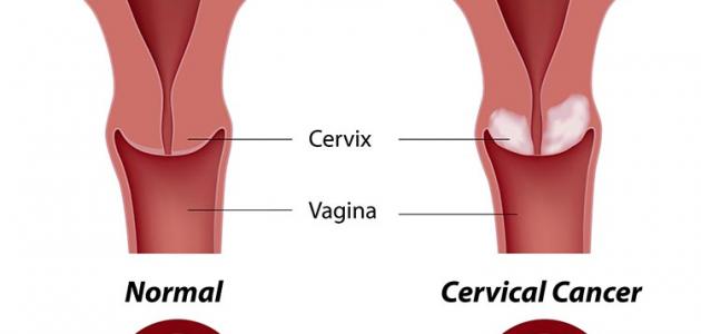 اعراض سرطان الرحم - كيف تعرفين انك اصبت بسرطان الرحم 2540 3