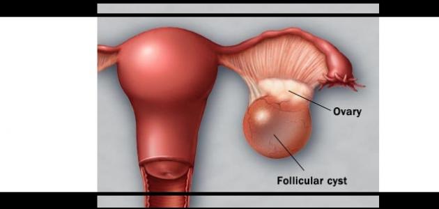اعراض تكيس المبايض , ما هى اعراض وعلامات تكيس المبايض