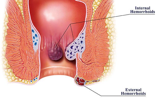 اعراض البواسير - معلومات عن مرض البواسير 2429 2