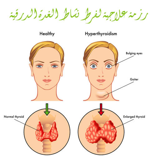 اعراض الغدة الدرقية - معلومات عن اغراض الغده الدرقيه 2597