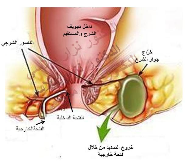 ما هو الناسور - اهم اعراض مرض الناسور 1674 2