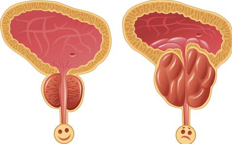 علاج البروستاتا - اسباب واعراض وتشخيص التهاب البروستاتا 4115 3
