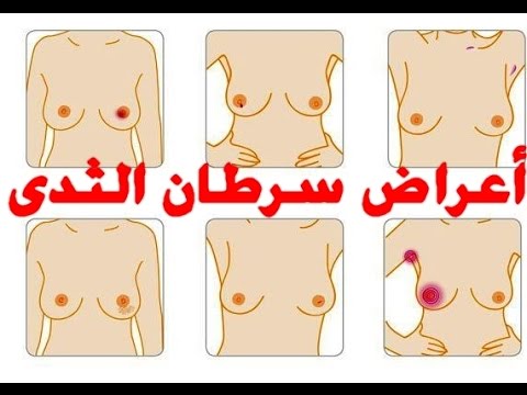 مرض سرطان الثدي - اعراض وعلاج سرطان الثدي 4765 3