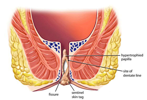 اعراض البواسير - معلومات عن مرض البواسير 2429 4