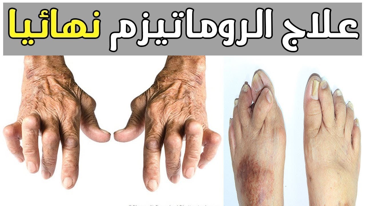 علاج الروماتيزم 5512 1