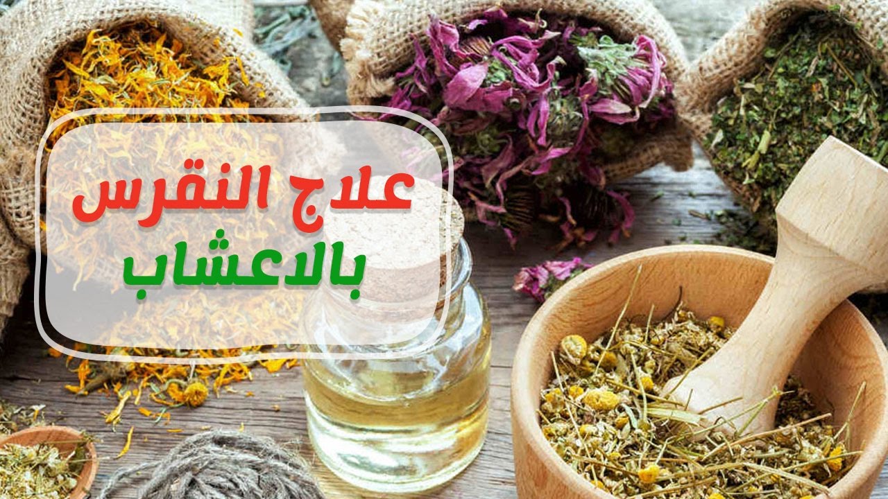 علاج النقرس بالاعشاب - النقرس والشفاء منه بابسط الاعشاب 3489 3