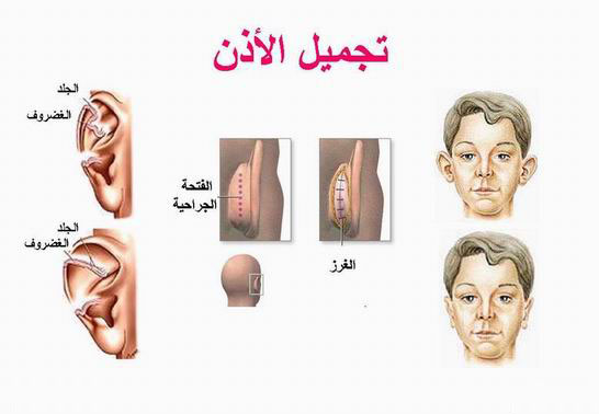 معلومات عن عملية تجميل الاذن , قد تسمعها لأول مره