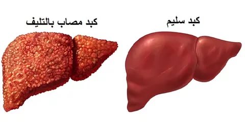 علاج تليف الكبد - العلاج الطبى الصحيح لتليف الكبد 3059 2