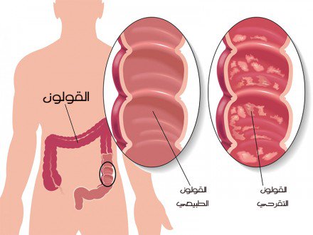 مرض القولون - اعراض القاولون العصبي و علاجه 827 2