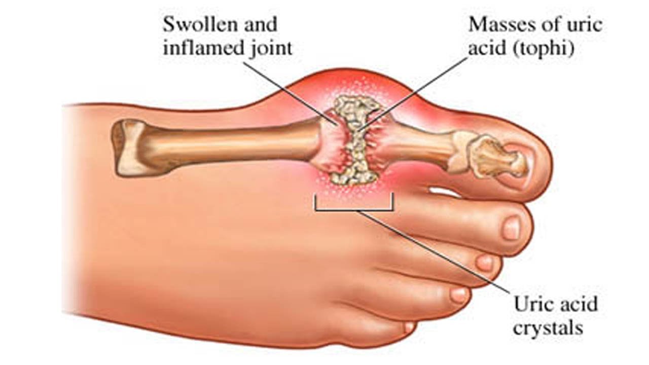 مرض النقرس - معلومات عن مرض النقرس 2487 2
