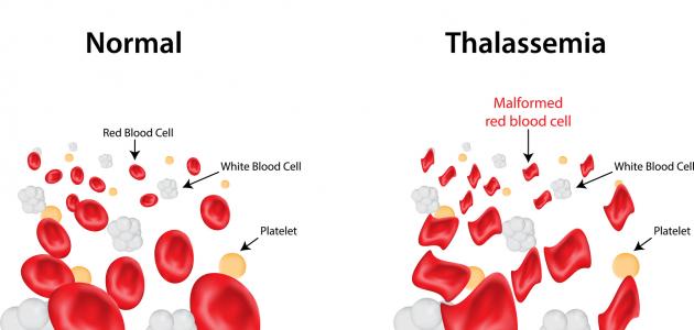 مرض الثلاسيميا - معلومات عن مرض الثلاسيميا 2603 3