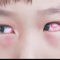 5978 2 علاج حساسية العين - طريقة علاج حساسية العين الاميرة ريمة